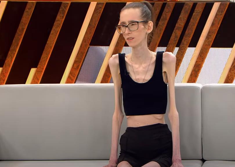 Ate 5 Peaches and Some Cheese Every Day to Lose Weight: Anastasija Now Weighs Only 29 Kilograms and Her Life is a Struggle