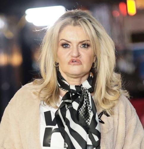 Glumica ponovo operisala lice nakon što se unakazila zavisnošču od droge: Kamere je snimile u Dubaiju Kép