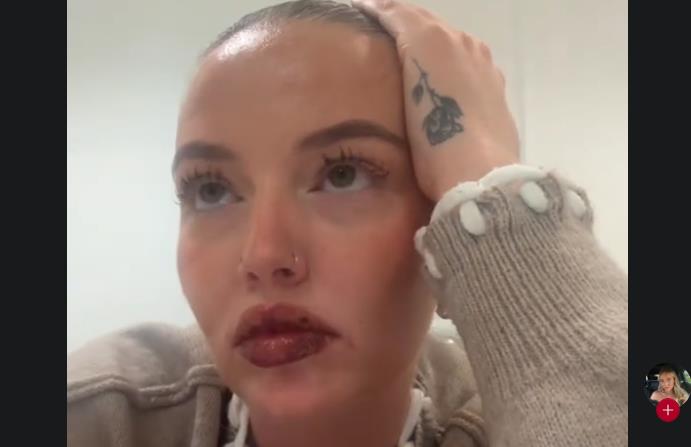 She Paid 460 EUROS for Fuller Lips, Then Went Through Hell: Didn't Leave the House for Two Weeks!