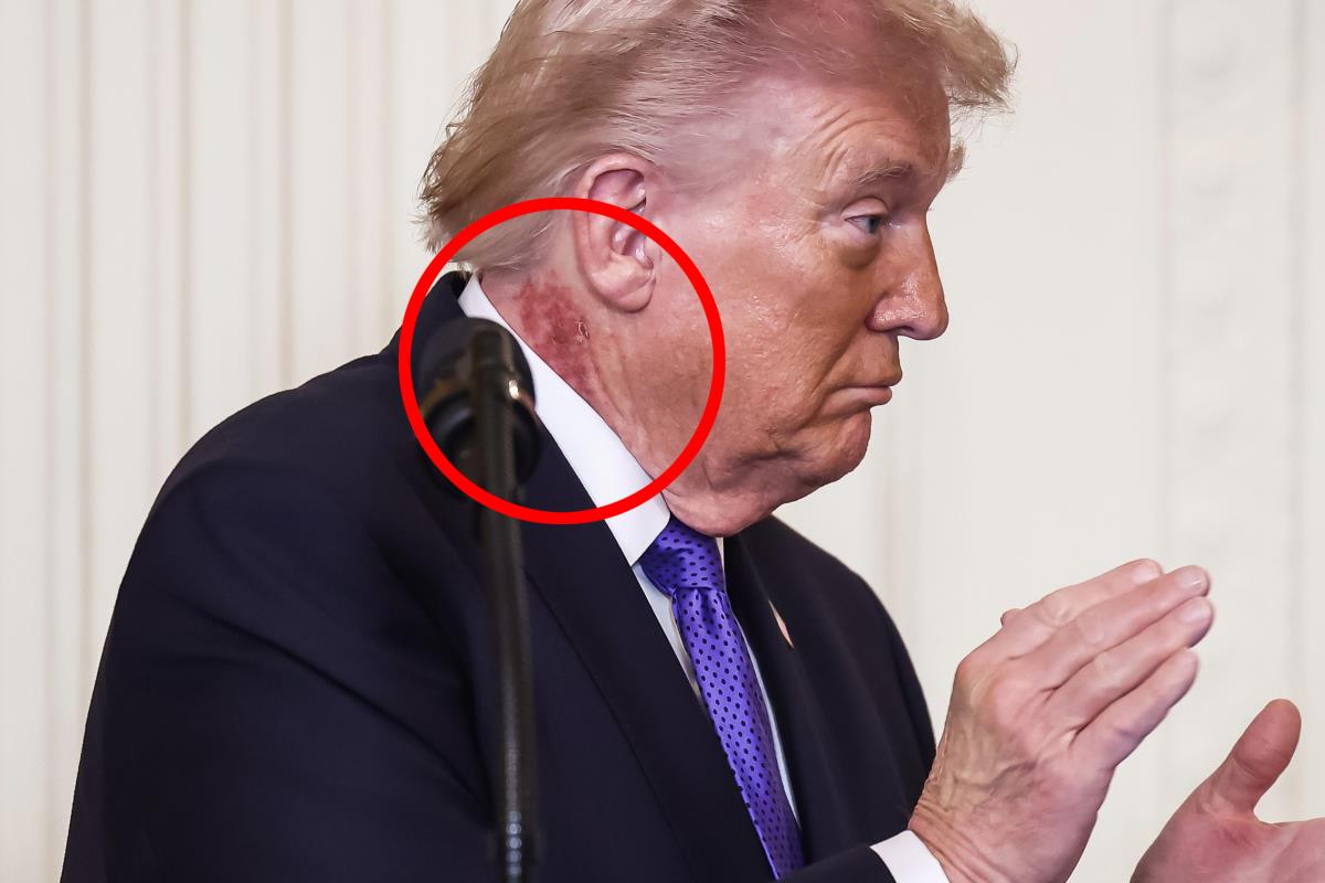 What is this on Trump's neck? In the shadow of the Middle East conflict, a mark on the US president raises doubts