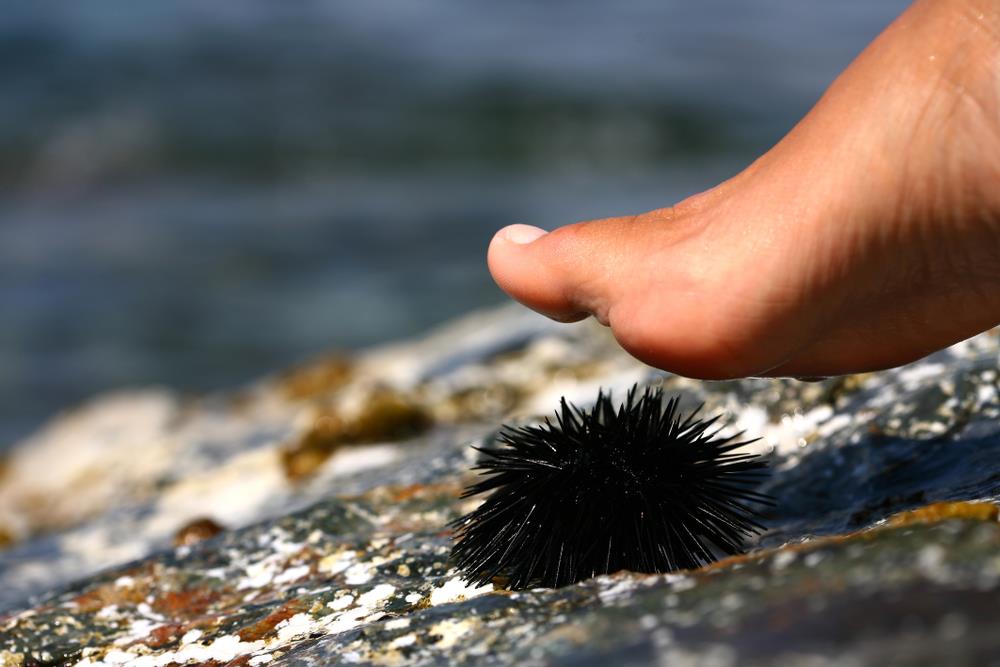 Tri stvari koje odmah morate uraditi ako nagazite na morskog ježa: Jedan trik iz kuhinje spasava letovanje!