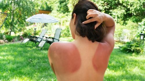 Dermatolog izneo niz saveta šta raditi ako ste jako izgoreli na suncu: Ove greške mnogi prave