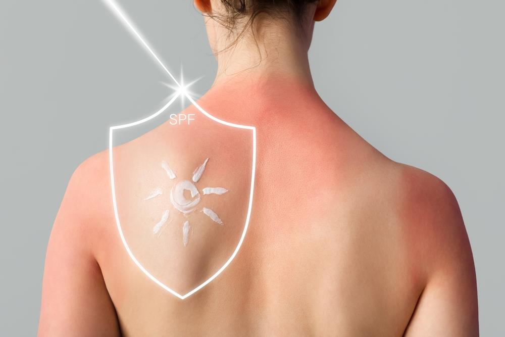 SPF 30 ili 50: Šta broj na kremi za sunčanje zaista govori i gde ljudi najčešće greše