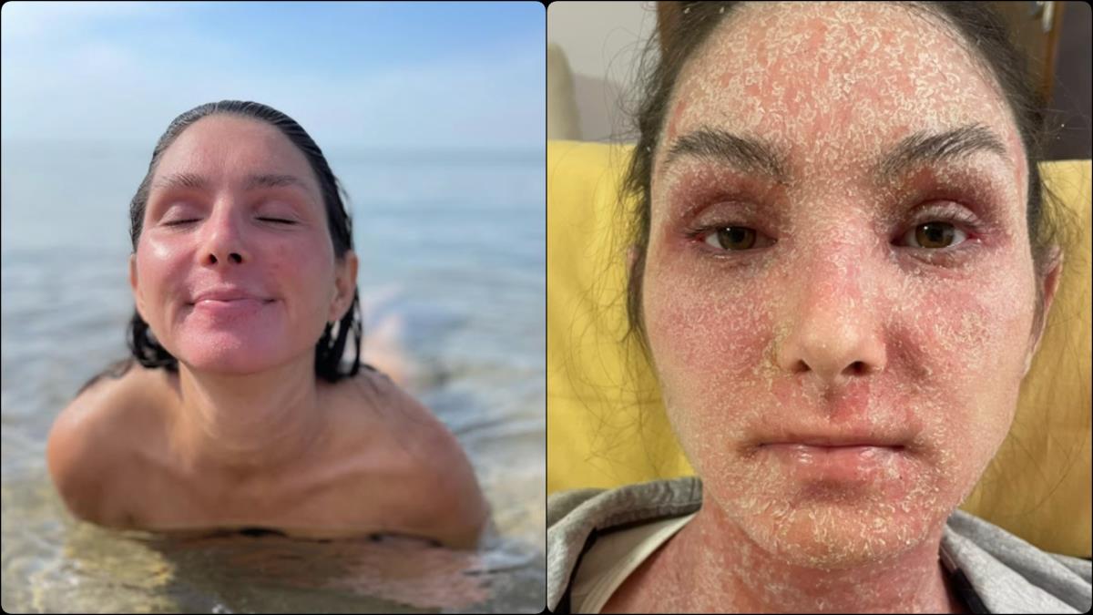 Prestala da koristi kreme sa kortikosteroidima i preživela pakao: Tanja pokazala svoju tešku borbu sa herpesom "Vrištala sam od bolova"