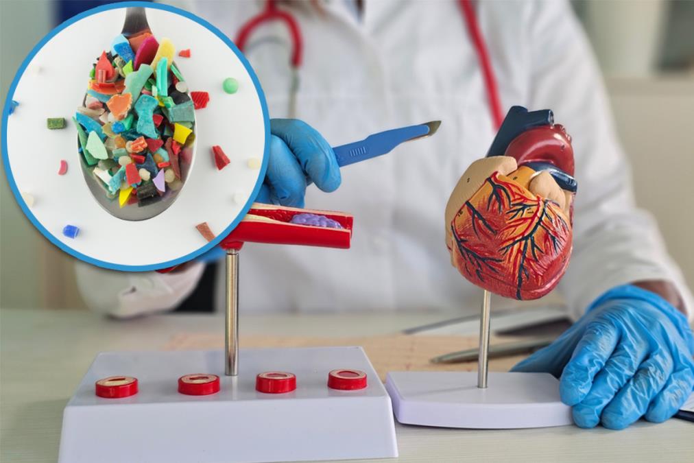 Mikroplastika pronađena u krvi većine žrtava srčanog udara: Nova studija otkrila zabrinjavajuću vezu sa bolestima srca