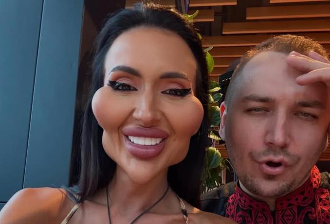 Anastasija rešila da se otarasi filera: Ima najveće obraze na svetu, a sad je upala u novi vrtlog estetskih operacija, evo kako je pre izgledala (FOTO)