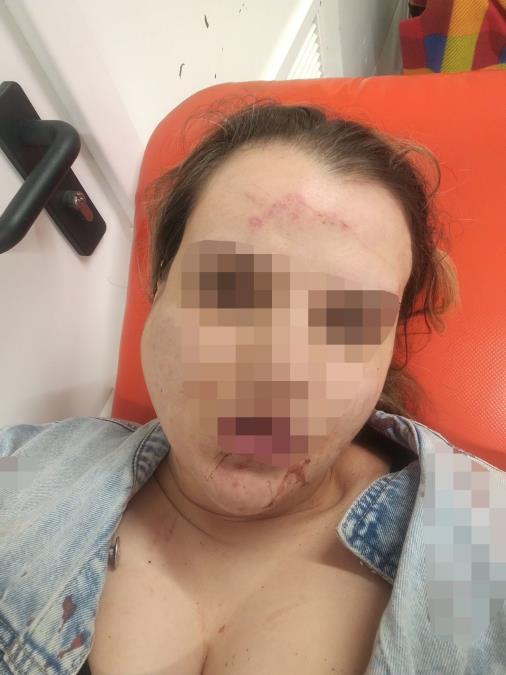 "SVE SLUŽBE SU SE PODIGLE NA NOGE, SAD SMO SIGURNI BAREM MESEC DANA" Nasilnik koji je ženi polomio vilicu i izbio zube na Kanarevom brdu ostaje iza rešetaka!