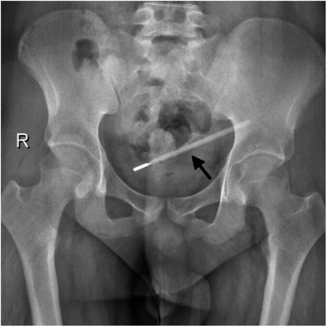 Došao u bolnicu zbog bolova u stomaku: Lekari zanemeli od šoka kad su videli šta je krio u sebi 20 godina, morao na hitnu operaciju