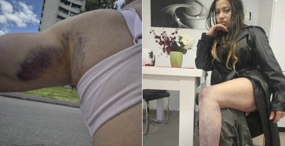 "BACALI SU ME PO ULICI, TELO MI JE PUNO MODRICA, IMAM POTRES MOZGA" Pevačica jezivo pretučena: Manijaci će me osakatiti