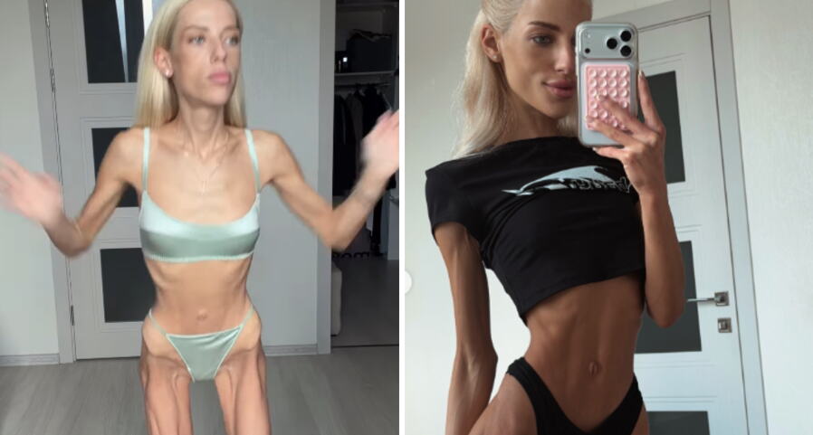 Violeta ima samo 32 kilograma i tvrdi da nije anoreksična: Kaže da redovno ide kod lekara, a evo šta je uzrok njenoj ekstremnoj mršavosti