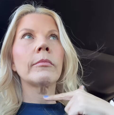 Otišla na zatezanje lica, pa zažalila pet meseci kasnije: "Razočarana sam, nisam bila svesna..." (foto/video)