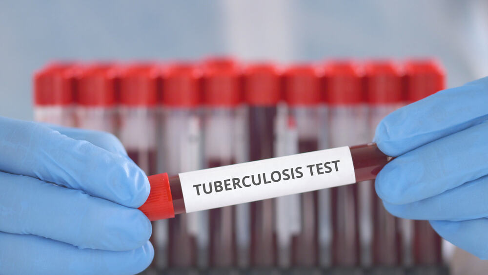Novi test krvi mogao bi da otkrije tuberkulozu mnogo ranije: Važan korak ka bržem lečenju ove podmukle bolesti