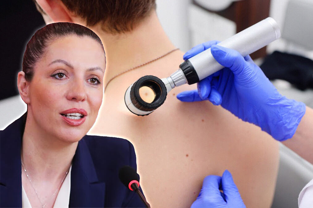 Za dva dana otkriveno 7 melanoma kod građana na KiM: Dr Tiodorović upozorava zašto su pregledi važni