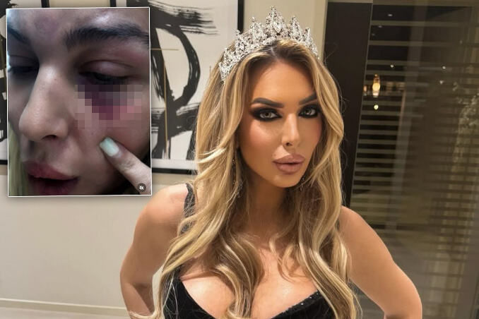 PRVE FOTOGRAFIJE BRUTALNO PRETUČENE AVE KARABATIĆ Starleta iznela potresne detalje: Terao me je da se snimam protiv moje volje