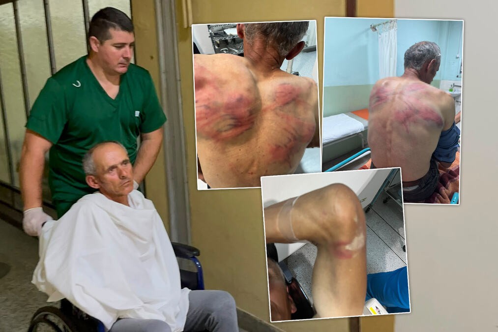 "TROJICA MI DOŠLA U KUĆU... VEZALI ME ZA BUKVU I TUKLI CREVOM" Iz bolnice se oglasio Nenad kog je Kurtijeva policija brutalno pretukla: Otkrio šta su mu tražili