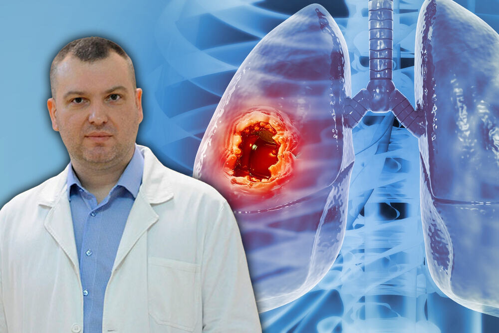 I kod metastatskog raka pluća danas je moguće petogodišnje preživljavanje: Dr Stjepanović najavljuje nove terapije od jeseni