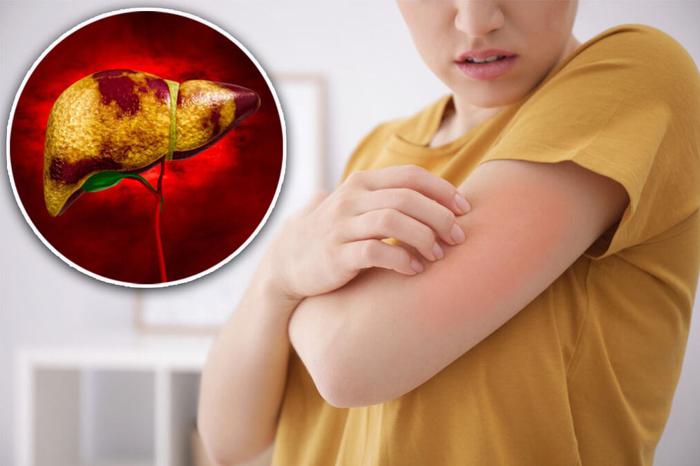Kada svrab kože ukazuje na probleme sa jetrom? Najčešće je bez osipa, a posebno se javlja noću