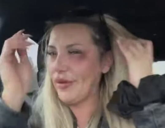 PRETUČENA NAŠA PEVAČICA! Kroz suze pokazala jezive modrice i podlive: Celo oko mi je poplavelo