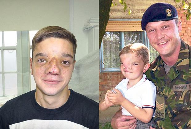 Pogledao je malog Stefana (4) i promenio mu sudbinu zauvek! Britanski vojnik dao novo lice srpskom dečaku: "Srce mi je puklo, oči su mi bile pune suza..."