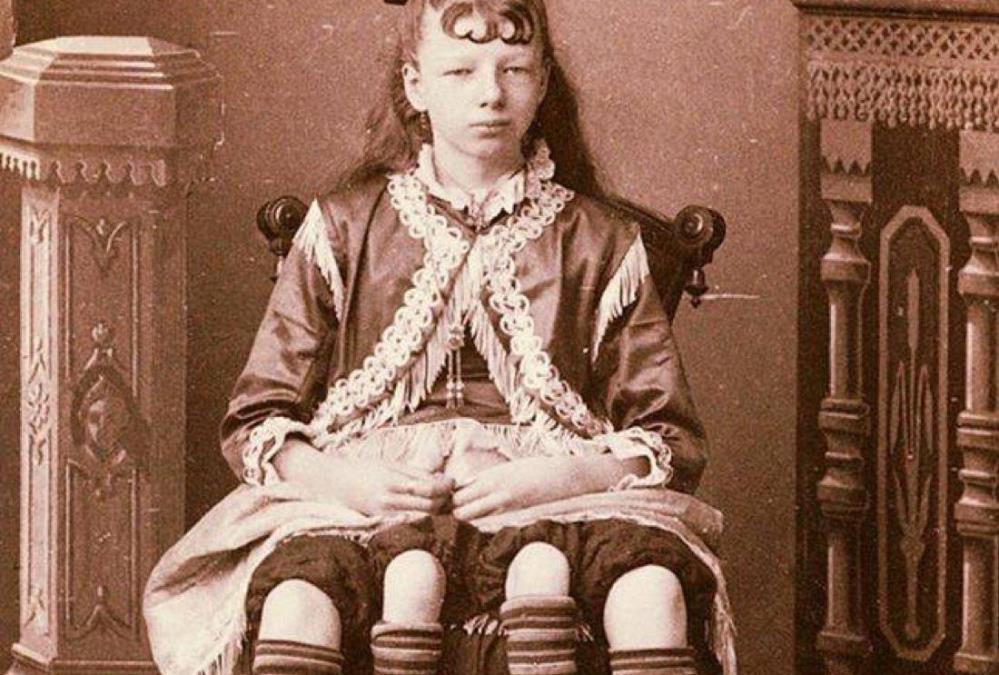 Rođena je sa 4 noge i 2 karlice, cela porodica zarađivala pare na njoj: Od svega pobegla u brak, pa rodila sedmoro dece