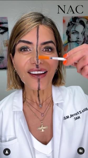 efekat botoksa 4.png