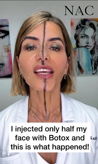 efekat botoksa 2.png