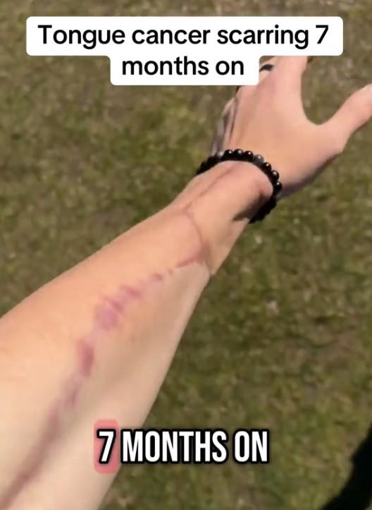 oziljci.jpg