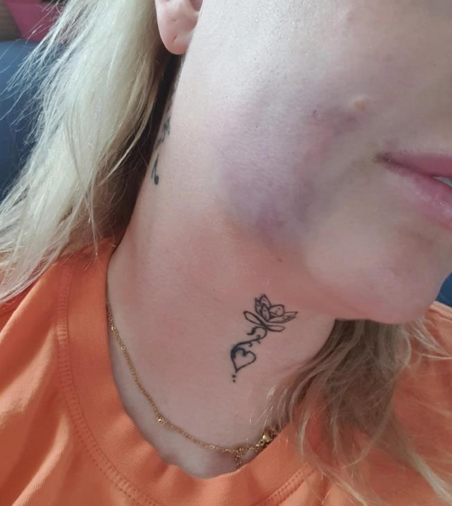 Lea otišla u Tursku da ugradi zubne implante i preživela pakao
