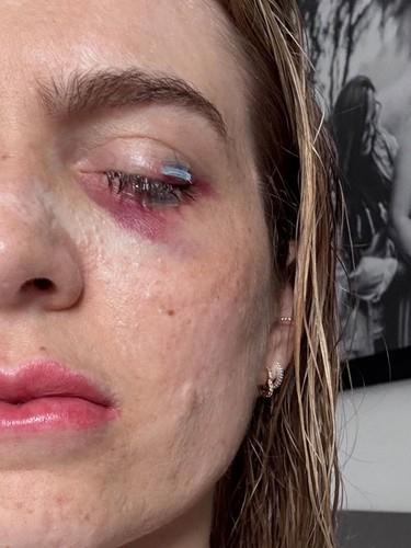 Žaklin Gmak tvrdi da je oslepela od ibuprofena