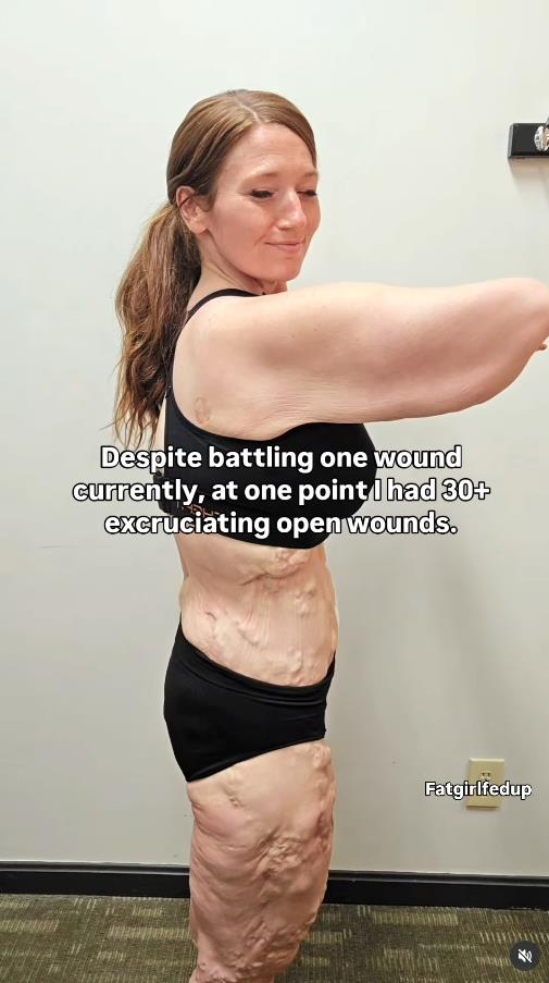 Leksi Rid pokazuje višak kože.jpg