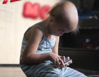 Aleksandra Guadajo - devojčica rođena bez kapaka