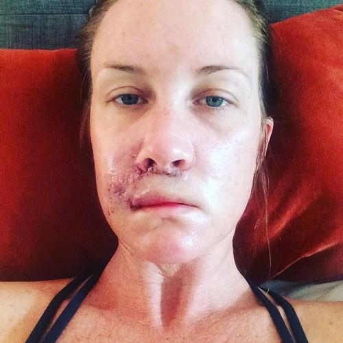 Kori Felc - probudila se tokom operacije raka kože na usni