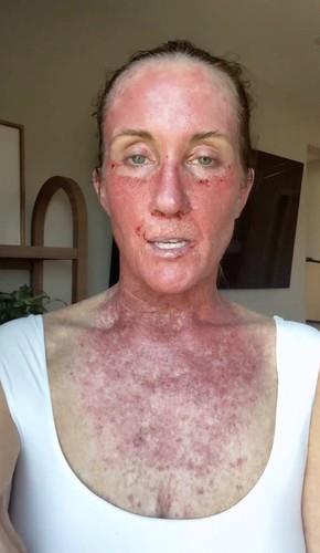 Kori Felc - probudila se tokom operacije raka kože na usni