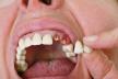 stockphotopatientholdbrokenartificialtoothbesideopenmouth99198908.jpg