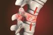 kicma-stockphotospinalfracturetraumaticvertebralinjurydillustrationcompressionfractureofthespine2023141736.jpg