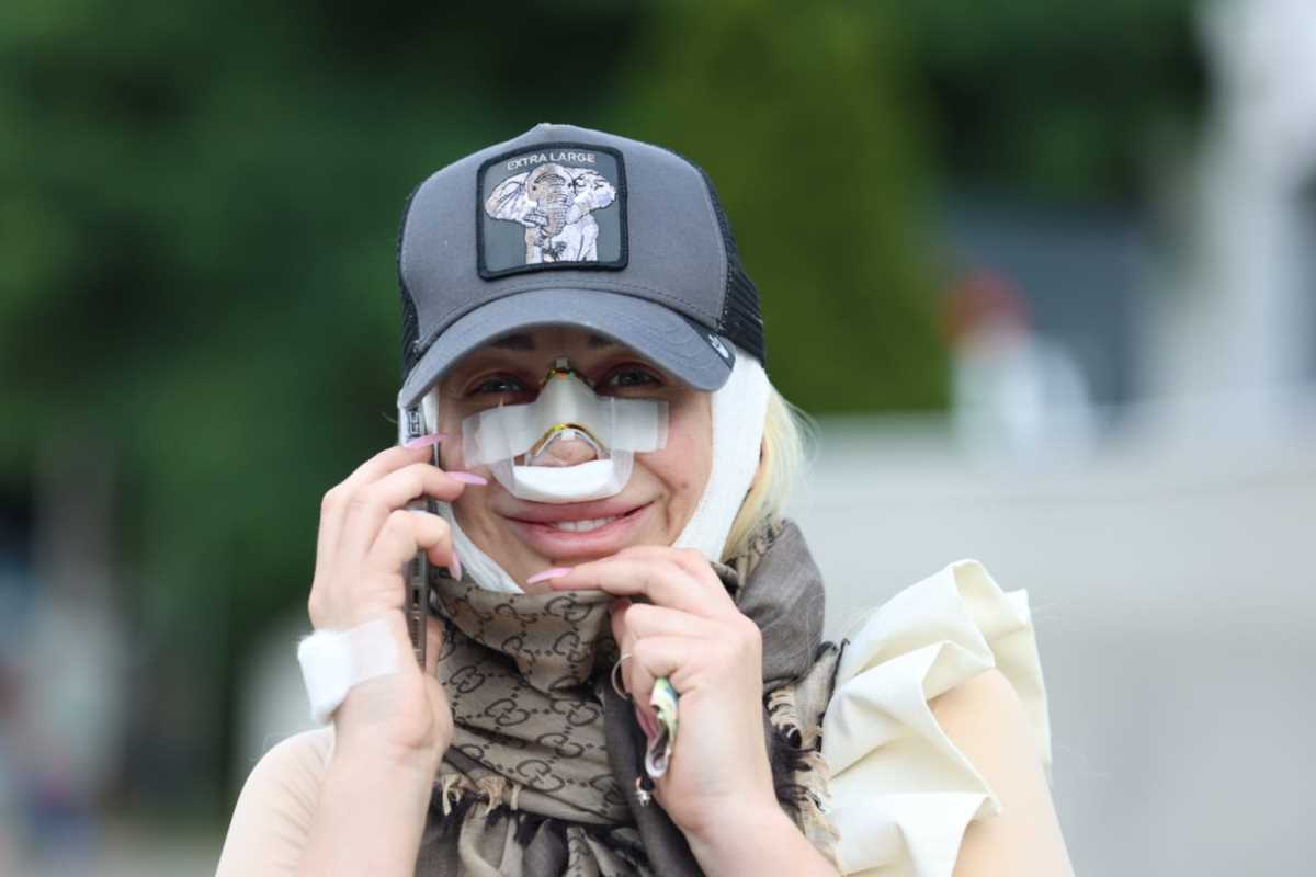 "NOS MI SE URUŠIO NA STRANU" Dušica Jakovljević izdeformisana - mora na sedmu operaciju