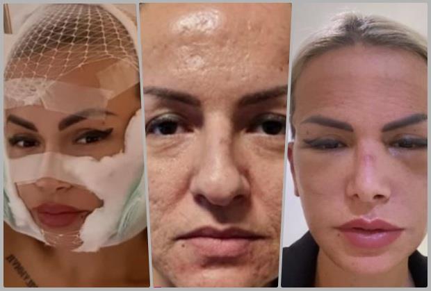 NEVEROVATNA TRANFORMACIJA ERMINE PAŠOVIĆ Bivša zadrugarka odavno ne liči na sebe, a ovo je spisak svih intervencija (FOTO)