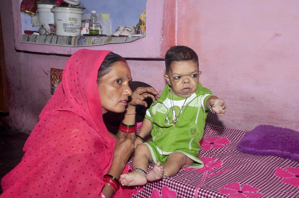 Ravi Kumar, odrastao čovek u telu deteta.jpg