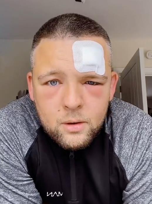 Džek Holmsa ujela konjska muva (9).jpg