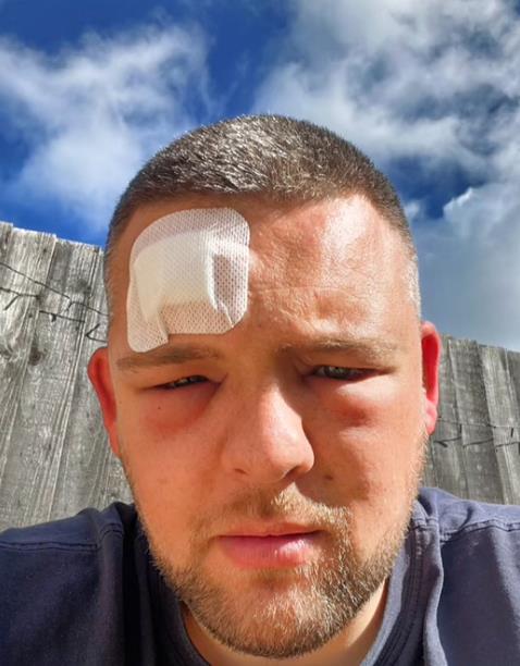 Džek Holmsa ujela konjska muva (8).png