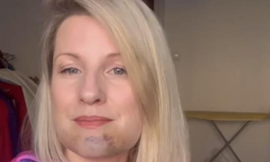 Lice pevačice ide Prester u podlivima i modricama