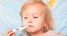 varicele-velike-boginje-shutterstock.jpg