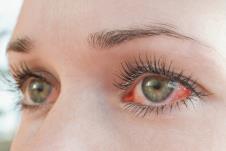 konjunktivitis-shutterstock-2091913834.jpg