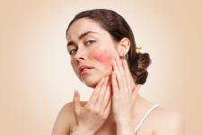 rozacea-shutterstock-1717579036.jpg