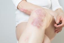 psorijaza-shutterstock-1717044862.jpg