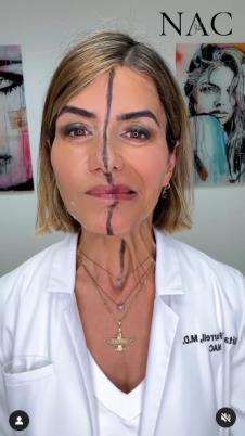 efekat botoksa 5.png