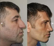 Muškarac pre i posle estetskih operacija lica – potpuno drugačiji izgled nakon osam meseci tretmana u Turskoj.