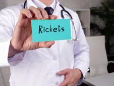 rahitis shutterstock_1884826321.jpg