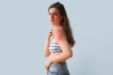 alergija sunce shutterstock_2320676071.jpg