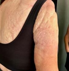 Sara Alum pokazuje ruku pre tetovaže